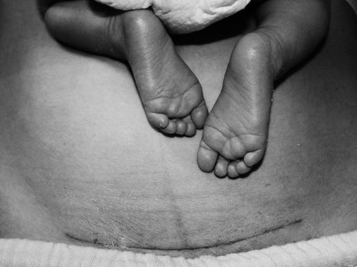 Top Tips for Caesarean Delivery and Recovery | Hotmilk